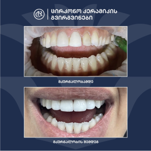 Zirconia Crowns Result